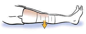 Leg from knee down showing quadriceps sets. Bandage on knee.