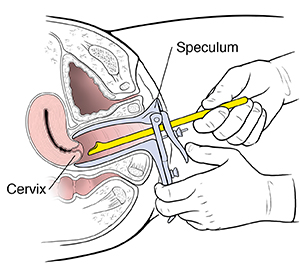 Cross section of pelvic area showing use of speculum and small spatula for pap test.