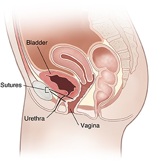 Side view cross section of female pelvis showing retropubic suspension.