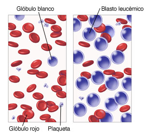 Vista microscópica de células sanguíneas en que se compara la sangre normal con la leucemia.