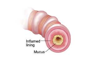 Cross section of bronchiole showing airway with inflamed lining and mostly blocked by mucus.